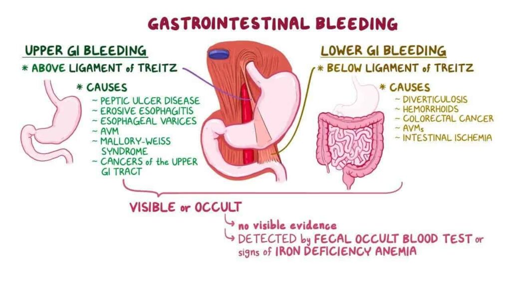 gi bleeding upper and lower, mnemonic, simple text